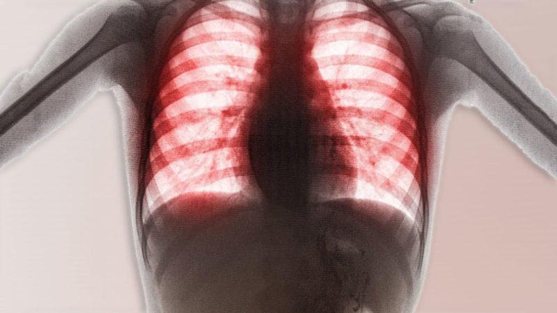 Üç Adet Deterjan Kapsülü Yutan Gencin Akciğerlerine Yaptığı Korkunç Kötülük!