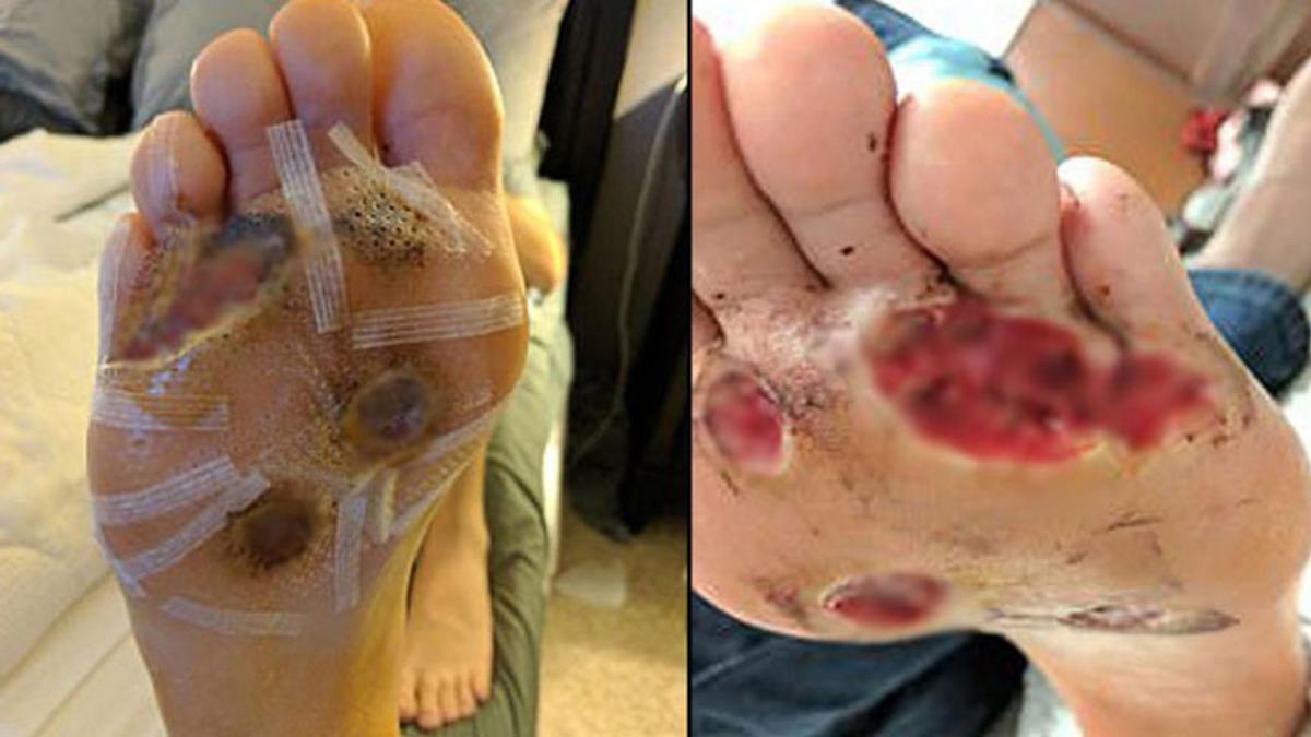 Çıplak Ayakla Spor Salonunun Duşuna Giren Adam, Et Yiyen Enfeksiyon Kaptı