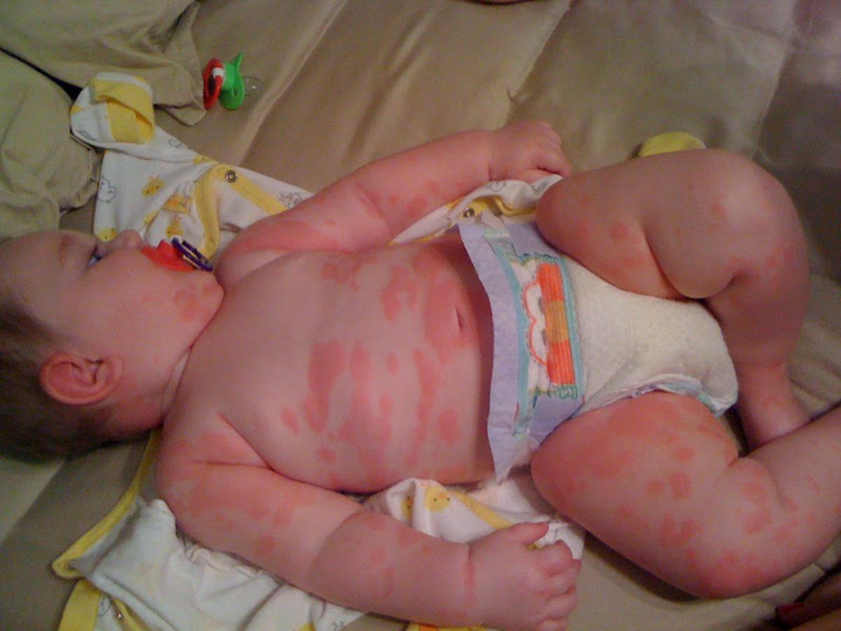 Araştırmacılar, Aslında Çoğu İnsanın Penisiline Alerjisinin Olmadığını Ortaya Çıkardı