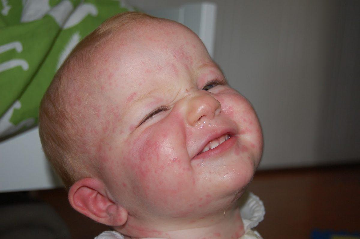 Araştırmacılar, Aslında Çoğu İnsanın Penisiline Alerjisinin Olmadığını Ortaya Çıkardı