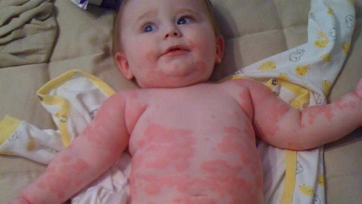 Araştırmacılar, Aslında Çoğu İnsanın Penisiline Alerjisinin Olmadığını Ortaya Çıkardı