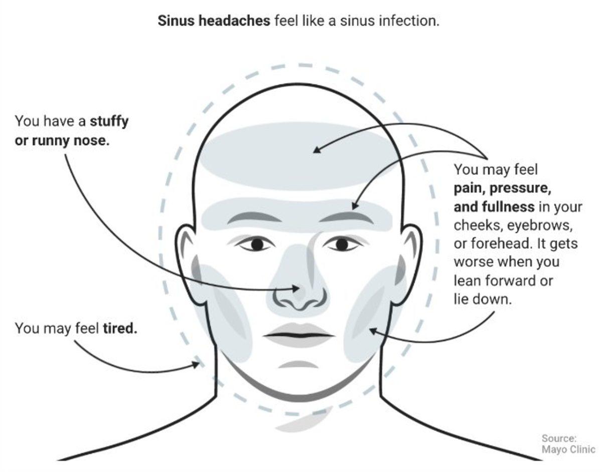 En Yaygın 3 Baş Ağrısı Türünün Sebebi ve Hissedildiği Bölgeler