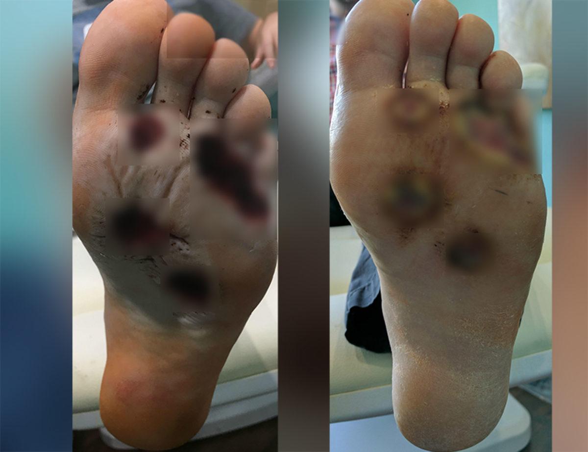 Yakalandığı Et Yiyen Bakteri Enfeksiyonu Sebebiyle Ayaklarının Altı Mahvolan Adamın Dramı