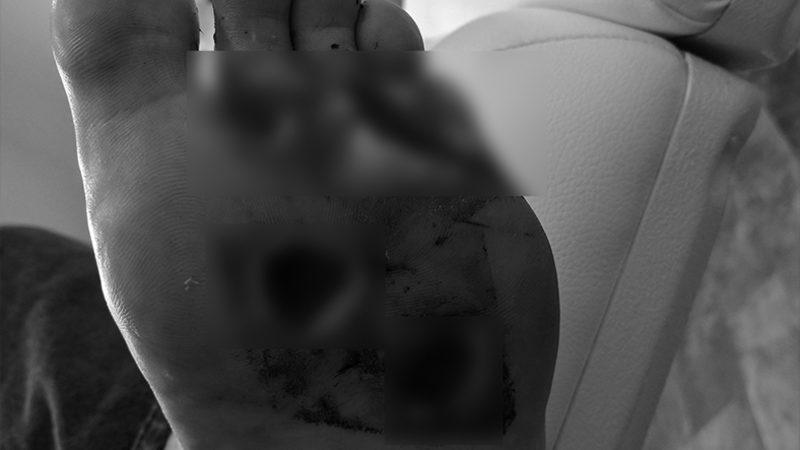 Yakalandığı Et Yiyen Bakteri Enfeksiyonu Sebebiyle Ayaklarının Altı Mahvolan Adamın Dramı