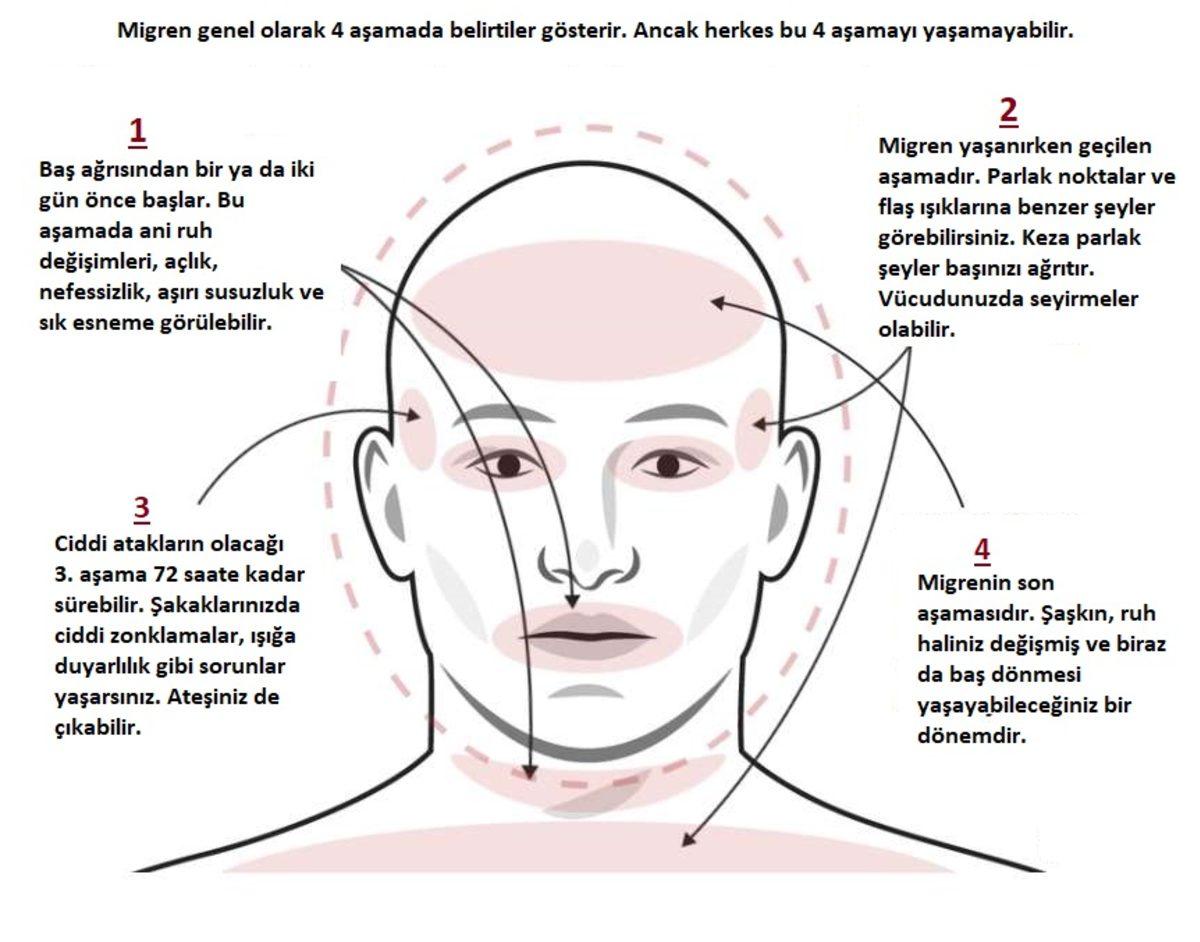 Baş Ağrınızın Sebebinin Migren Olup Olmadığını Nasıl Anlarsınız?