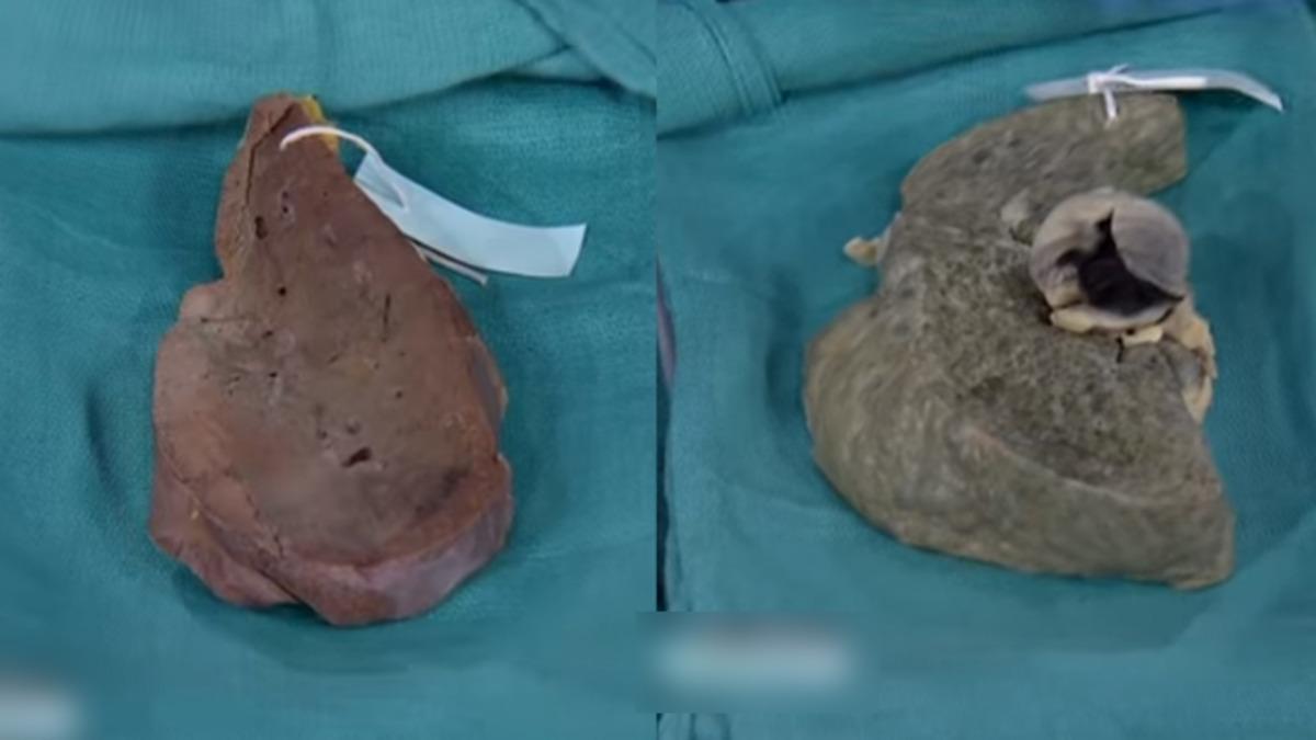 Aşırı Alkol Tüketiminin Karaciğeri Düşürdüğü Korkunç Durum! (Video)