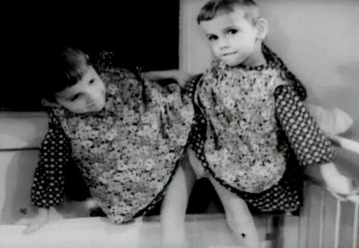 Bilim Adı Altında Birçok İşkenceye Maruz Bırakılmış Yapışık İkizlerin Yürek Burkan Hikayesi