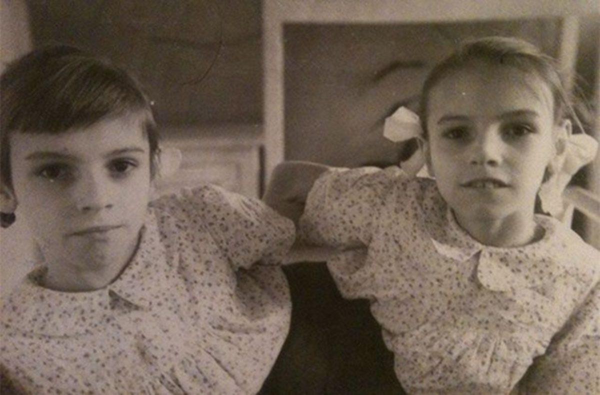 Bilim Adı Altında Birçok İşkenceye Maruz Bırakılmış Yapışık İkizlerin Yürek Burkan Hikayesi