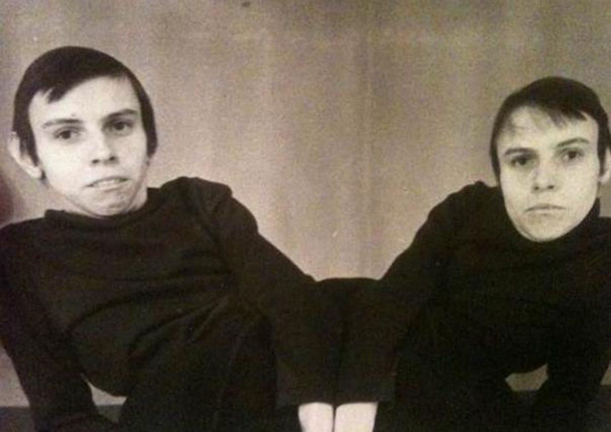 Bilim Adı Altında Birçok İşkenceye Maruz Bırakılmış Yapışık İkizlerin Yürek Burkan Hikayesi