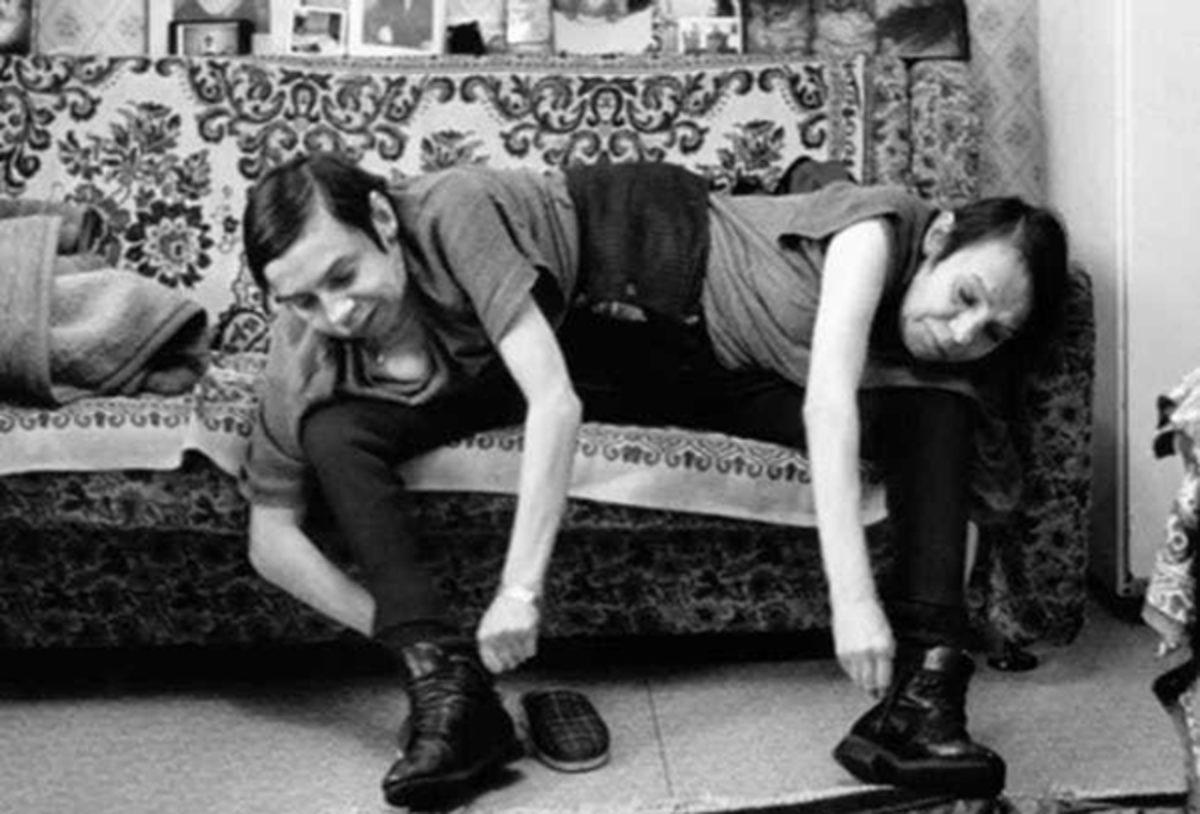 Bilim Adı Altında Birçok İşkenceye Maruz Bırakılmış Yapışık İkizlerin Yürek Burkan Hikayesi