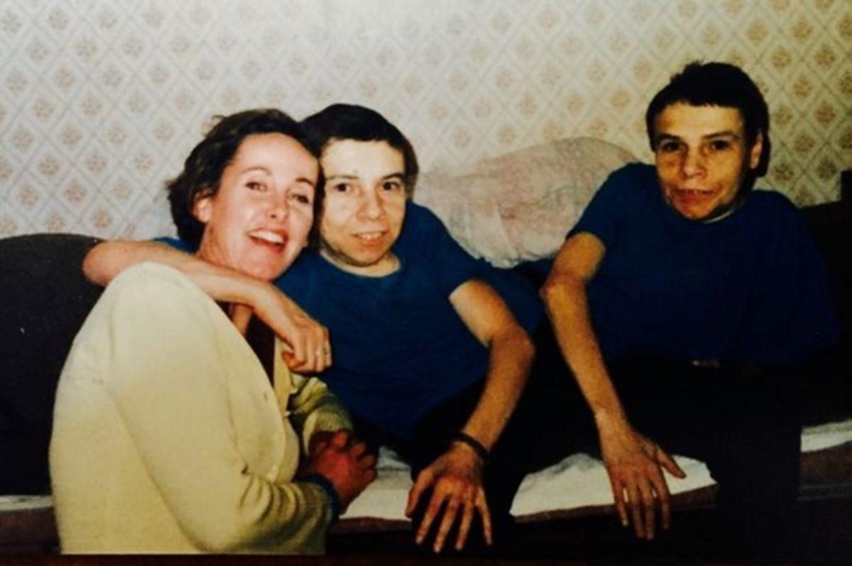 Bilim Adı Altında Birçok İşkenceye Maruz Bırakılmış Yapışık İkizlerin Yürek Burkan Hikayesi