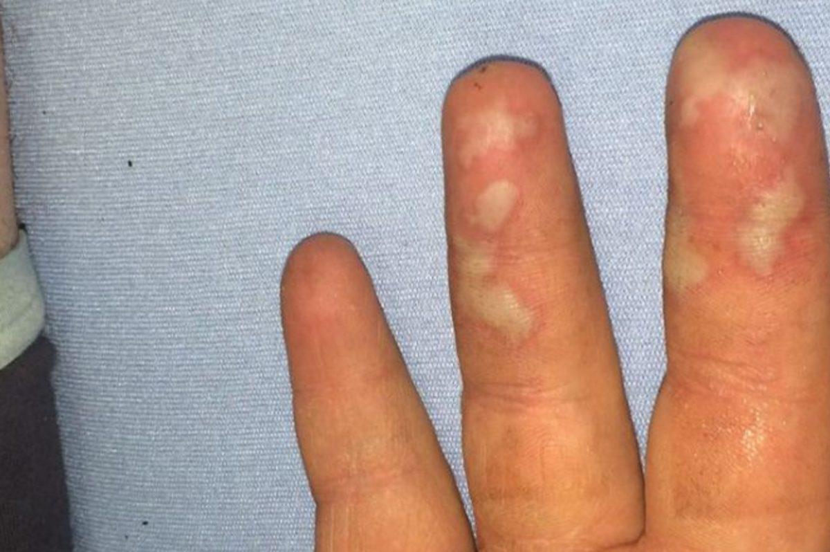iPhone’un Patlamasıyla Odada Çıkan Yangının Sonu Kötü Oldu