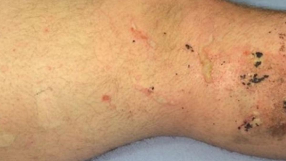 iPhone’un Patlamasıyla Odada Çıkan Yangının Sonu Kötü Oldu