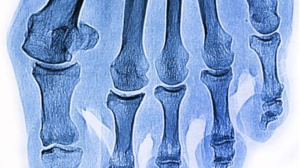 Kırık Kemiklerle İlgili Doğru Olduğu Zannedilen 5 Yanlış