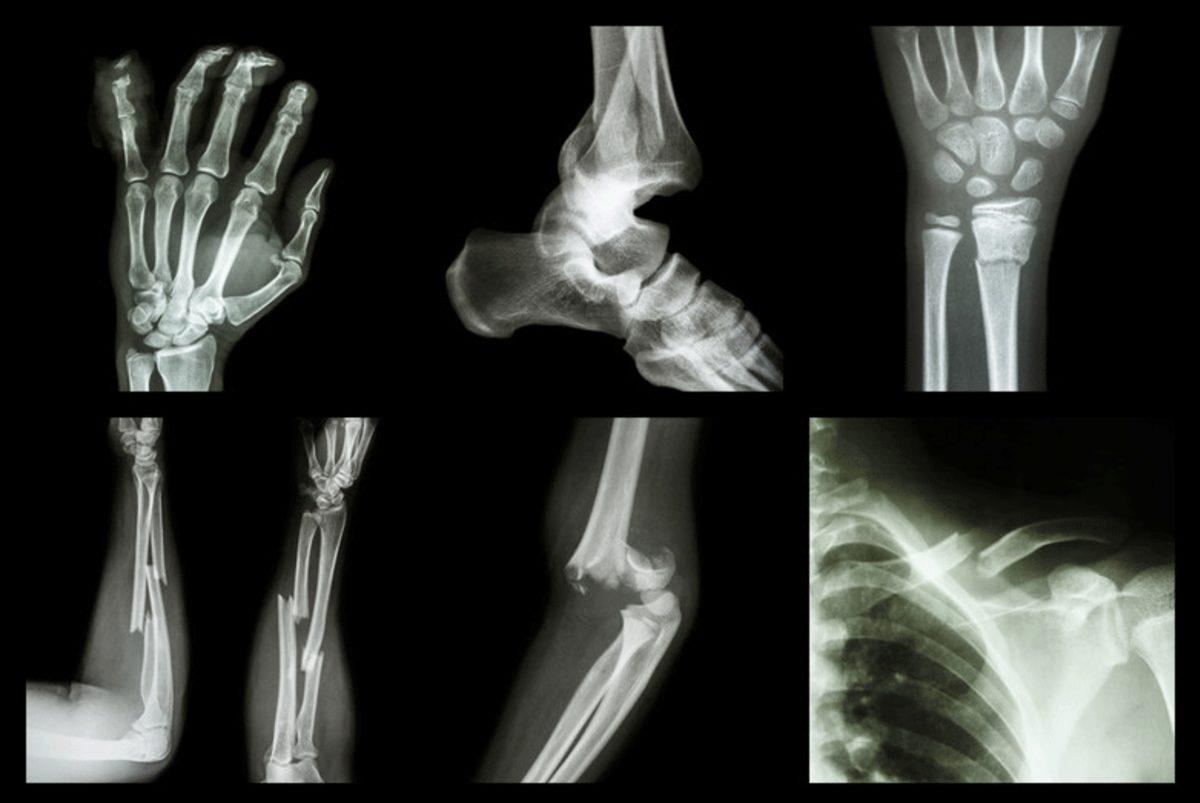 Kırık Kemiklerle İlgili Doğru Olduğu Zannedilen 5 Yanlış