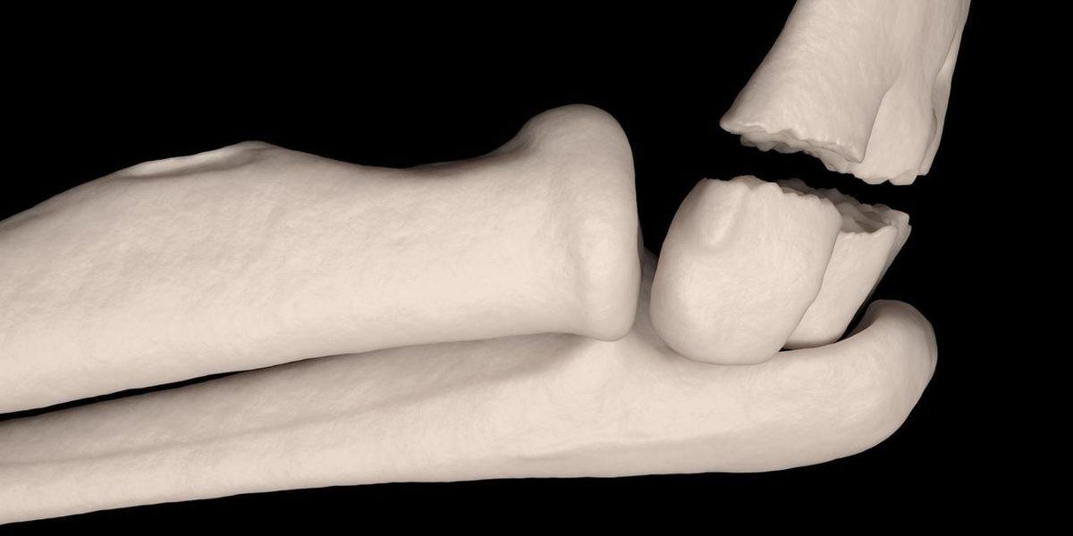 Kırık Kemiklerle İlgili Doğru Olduğu Zannedilen 5 Yanlış