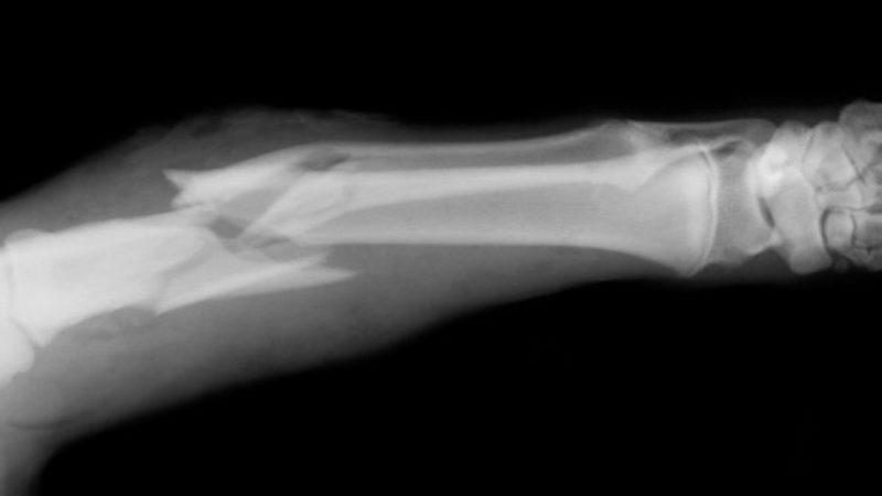 Kırık Kemiklerle İlgili Doğru Olduğu Zannedilen 5 Yanlış