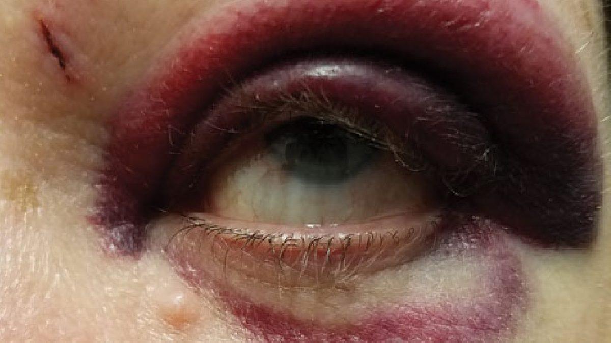 Vücudumuzda Darbe Alan Yerler Neden Morarır? Tedavi Yöntemleri Neler?