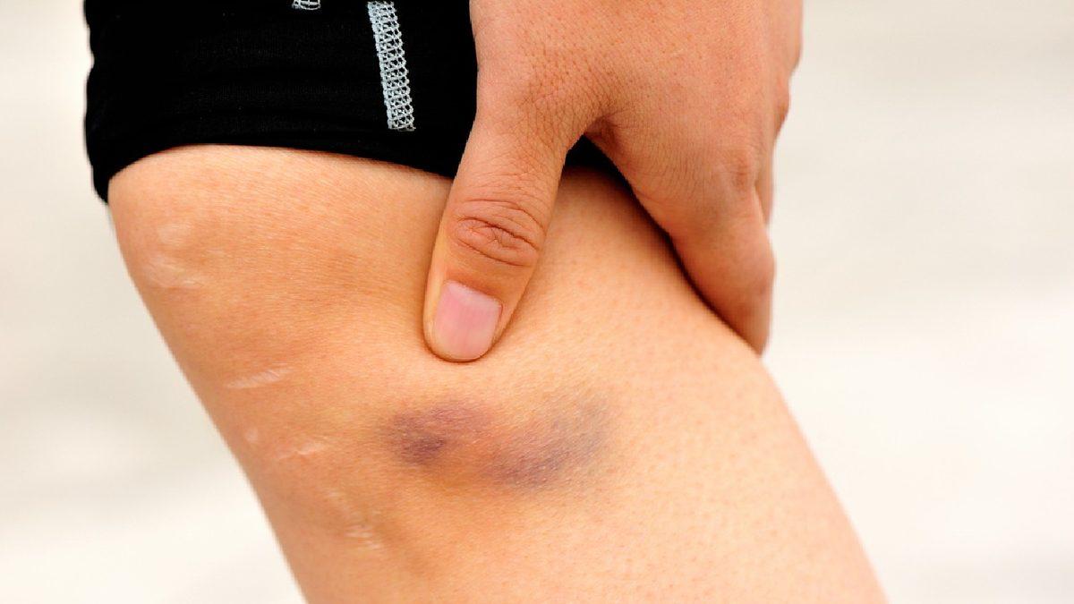 Vücudumuzda Darbe Alan Yerler Neden Morarır? Tedavi Yöntemleri Neler?