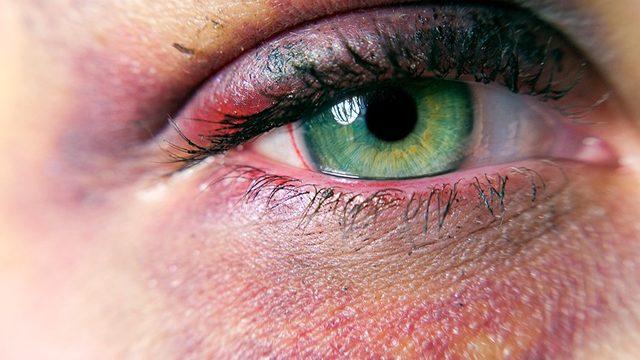 Vücudumuzda Darbe Alan Yerler Neden Morarır? Tedavi Yöntemleri Neler?