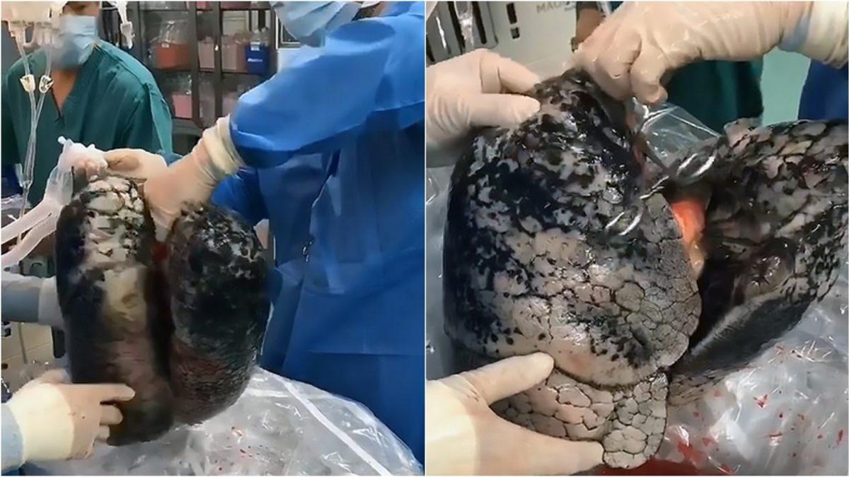 30 Yıl Boyunca Her Gün 1 Paket Sigara İçen Adamın Akciğerinin İçler Acısı Son Hali