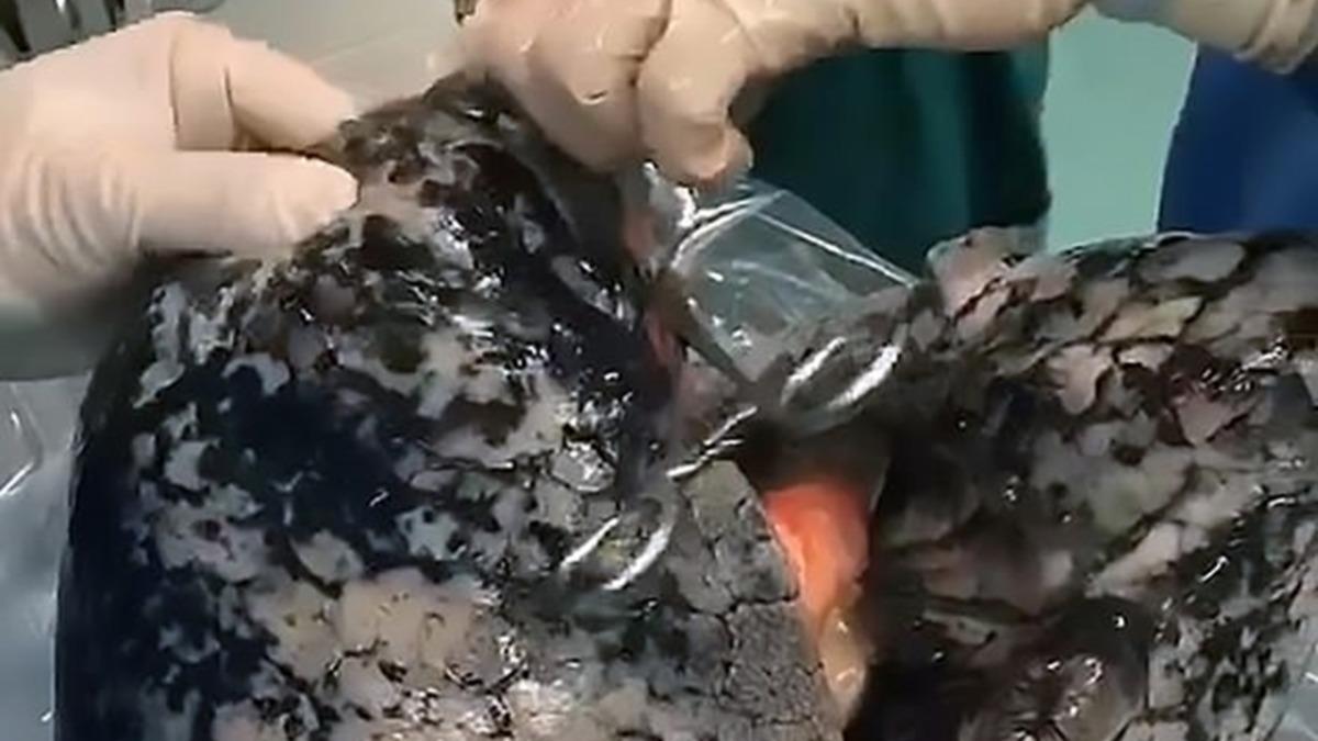 30 Yıl Boyunca Her Gün 1 Paket Sigara İçen Adamın Akciğerinin İçler Acısı Son Hali