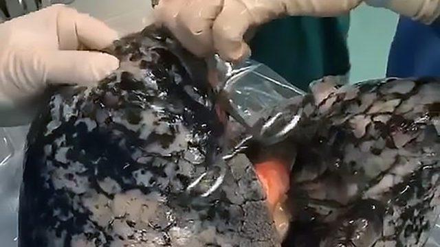 30 Yıl Boyunca Her Gün 1 Paket Sigara İçen Adamın Akciğerinin İçler Acısı Son Hali