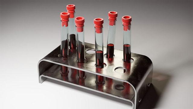 Anemi Hastalığını Teşhis Eden MCHC Nedir, Ne Anlama Gelir?