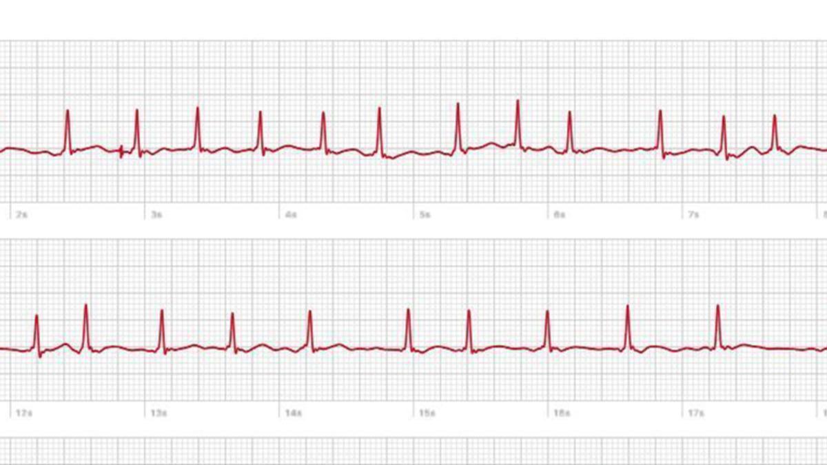 Bir Kullanıcı, Apple Watch’un EKG Uygulaması Sayesinde Kalp Rahatsızlığını Keşfetti