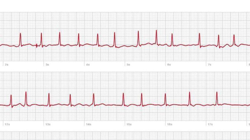 Bir Kullanıcı, Apple Watch’un EKG Uygulaması Sayesinde Kalp Rahatsızlığını Keşfetti