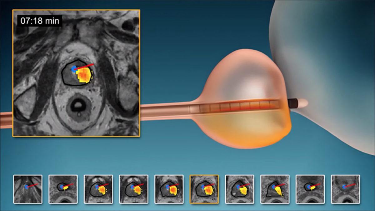 Yeni Tedavi Yöntemi ile Prostat Kanserli Katılımcıların Yüzde 80’i Tedavi Edildi