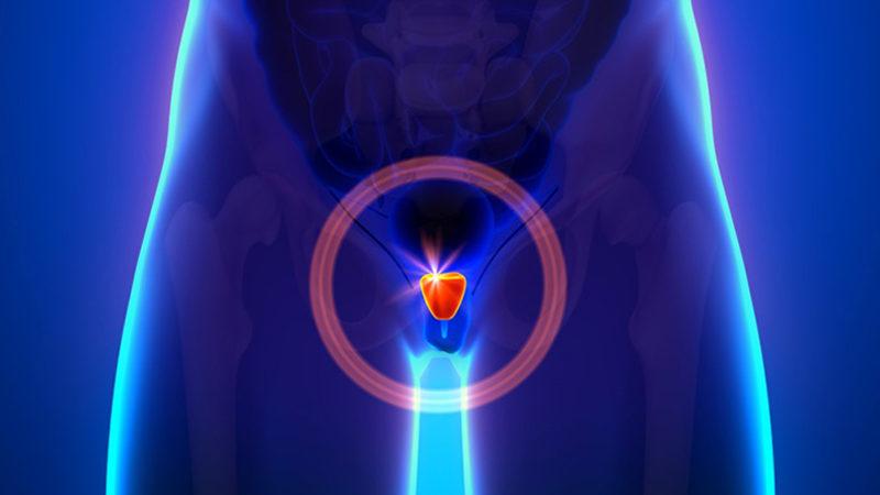 Yeni Tedavi Yöntemi ile Prostat Kanserli Katılımcıların Yüzde 80’i Tedavi Edildi