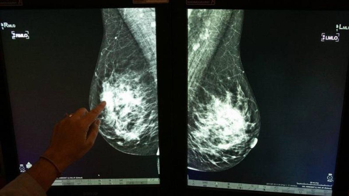 Meme Kanserini Erkenden Tespit Edebilecek Yapay Zeka Geliştiriliyor