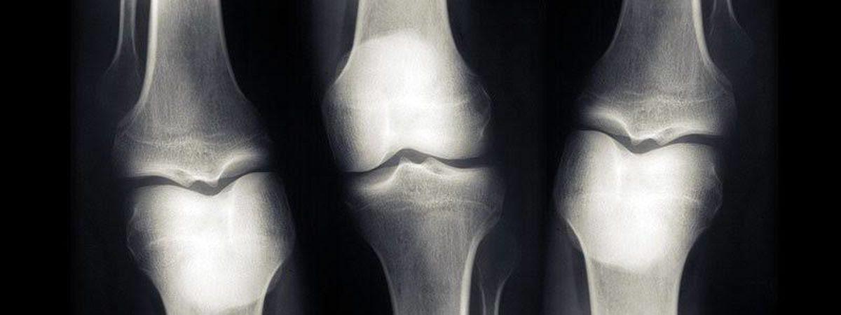 Bilim İnsanları, Hava Kirliliği ve Kemik Erimesi Arasında Bir Bağlantı Keşfetti