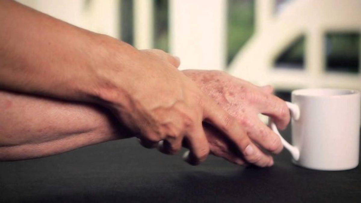 Bilim İnsanları, Parkinson Hastalığının Nerede Başladığını Keşfetti