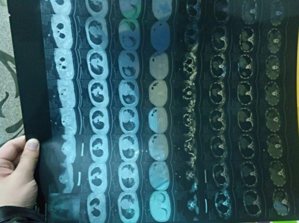 Corona Virüsünün Akciğerlere Verdiği Tahribatı Gösteren Tomografi Filmi