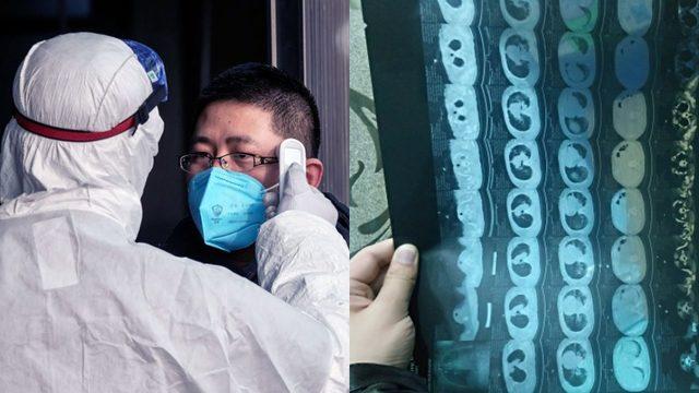 Corona Virüsünün Akciğerlere Verdiği Tahribatı Gösteren Tomografi Filmi