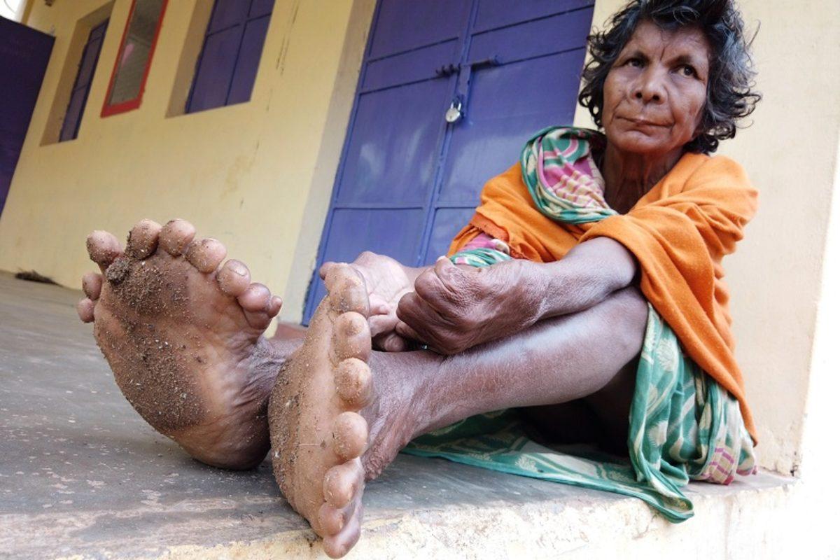 Doğuştan 31 Parmağa Sahip Olan Bir Kadın, Komşularından Cadı Damgası Yedi