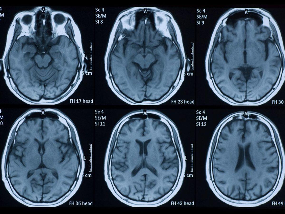 Beynimizin %10’unu Kullandığımız Efsanesi Neden Büyük Bir Yalan?