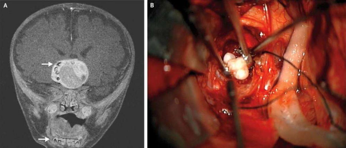 Doktorlar, Bir Bebeğin Beyninde Tamamen Gelişmiş Bir Diş Buldular
