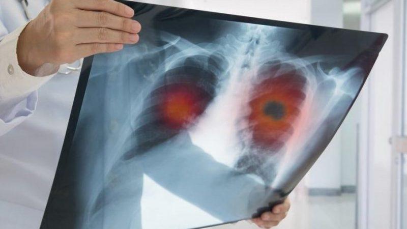 Elektronik Sigara Kaynaklı Ölümcül Bir Akciğer Rahatsızlığı Bulundu