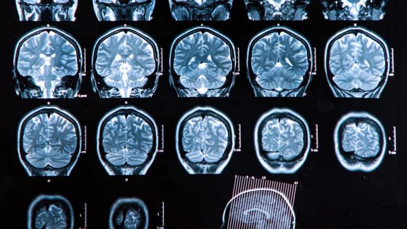 Makine Öğrenme İle Yeni Bir Tür Şizofreni Tespit Edildi