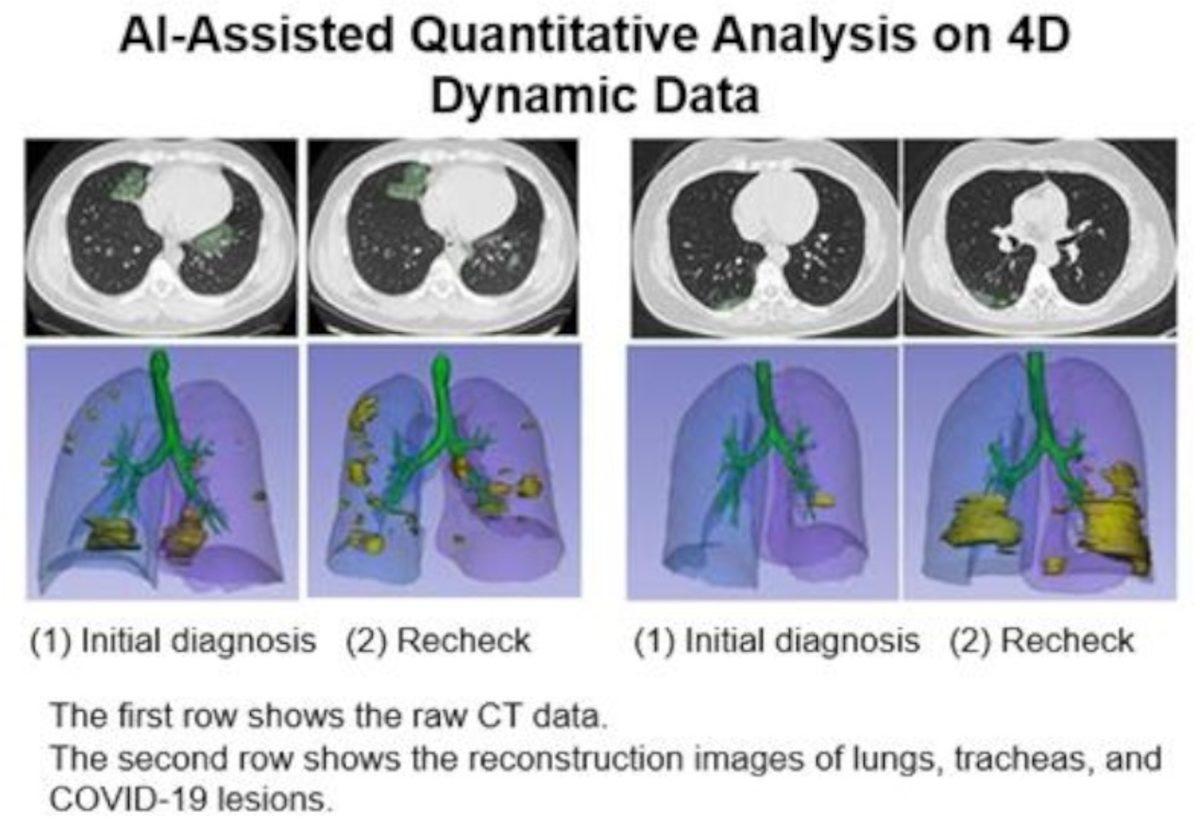 Huawei, Yapay Zeka Destekli Koronavirüs Tanı Hizmeti Geliştirdi