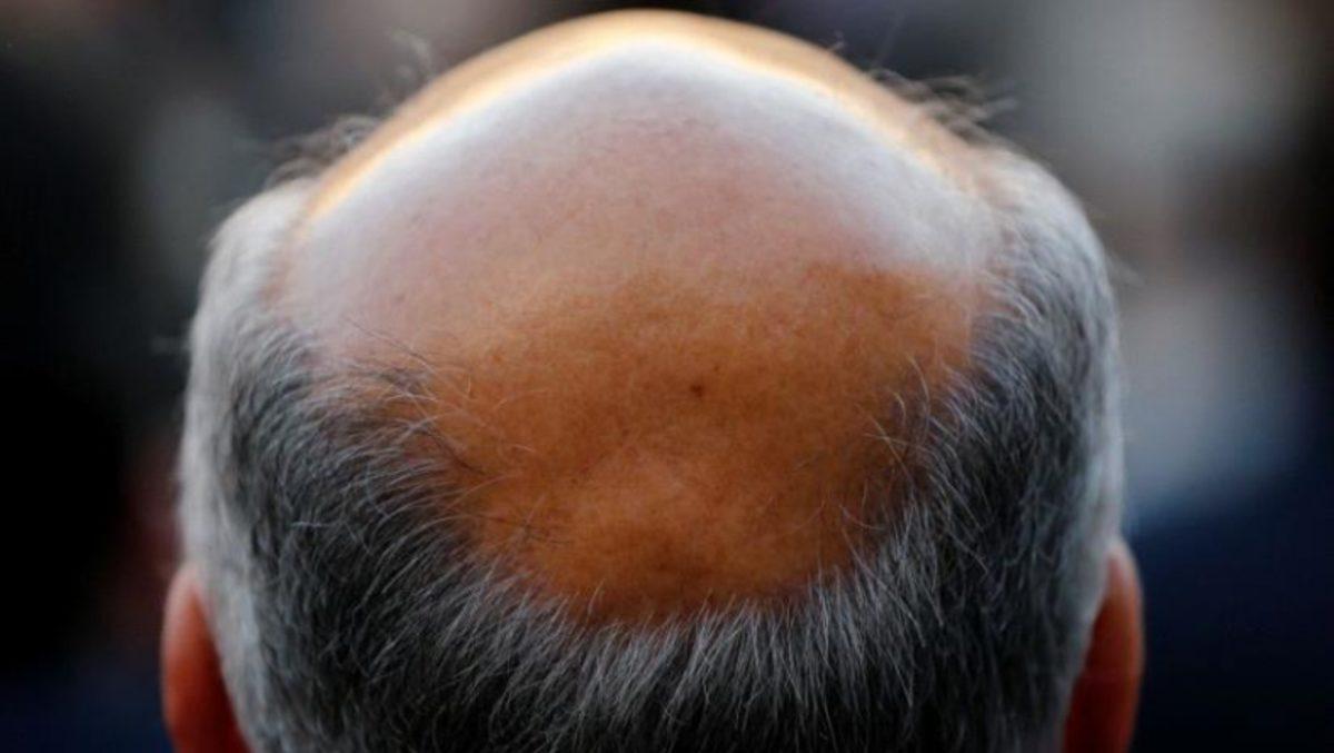 Bilim İnsanları, Saç Dökülmesini Tersine Çevirecek Bir Teknik Geliştirdi