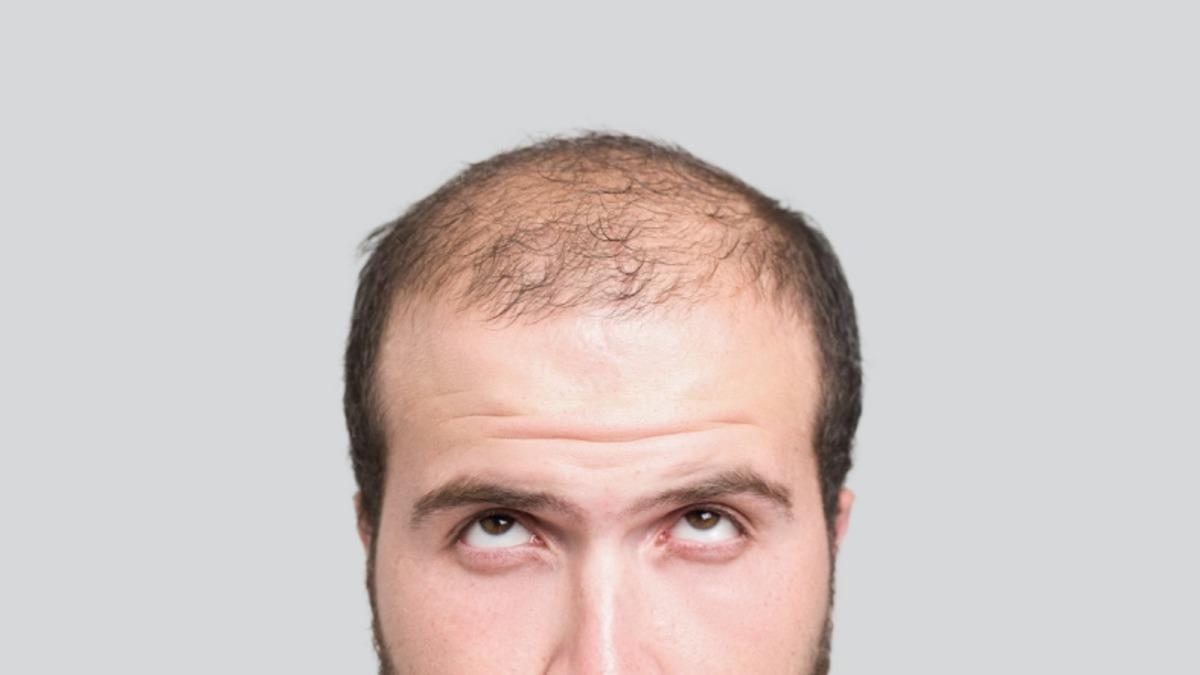 Bilim İnsanları, Saç Dökülmesini Tersine Çevirecek Bir Teknik Geliştirdi