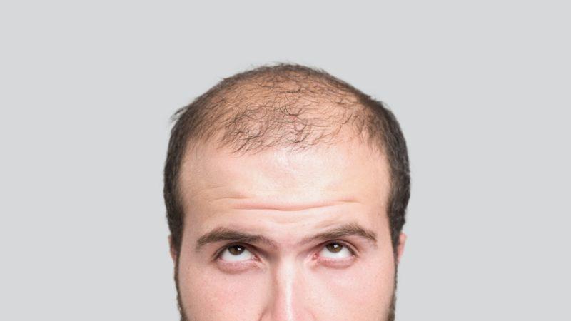 Bilim İnsanları, Saç Dökülmesini Tersine Çevirecek Bir Teknik Geliştirdi