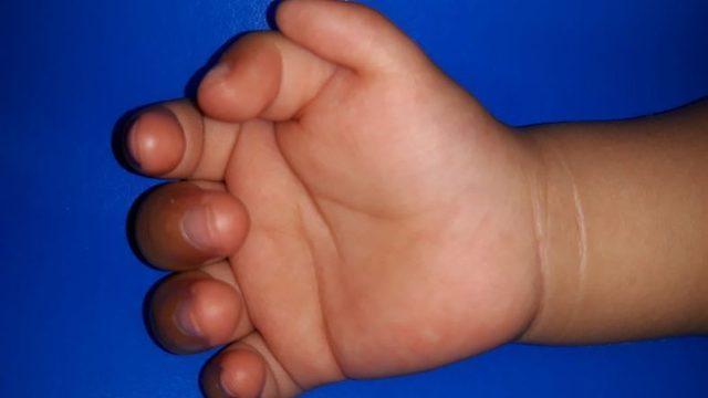 Araştırmaya Göre Altıncı Parmaklar, Doktorların Söylediği Kadar Kullanışsız Değiller