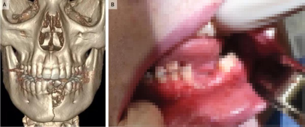 Ağzında Elektronik Sigara Patlayan 17 Yaşındaki Gencin Çenesi Kırıldı