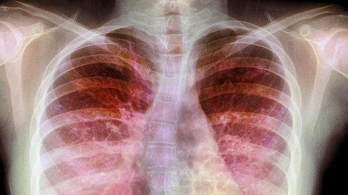 Koronavirüse Karşı Etkili Olduğu Söylenen ’Dornaz Alfa’ İlacı Hakkında Gerçekler