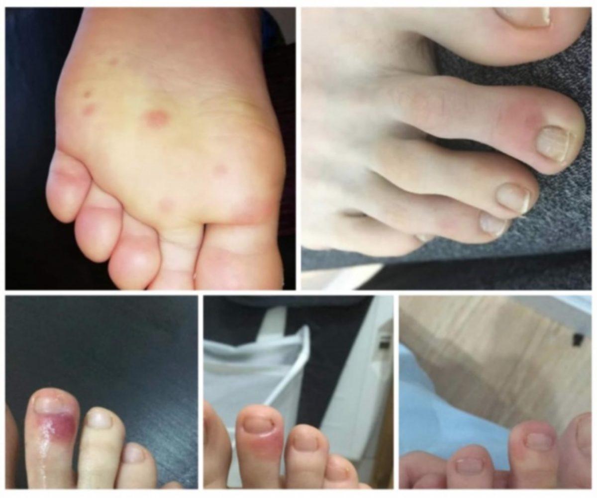 COVID-19’un Yeni Bir Semptomu Daha Keşfedildi